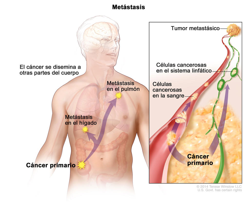 Pronostico vida higado metastasis